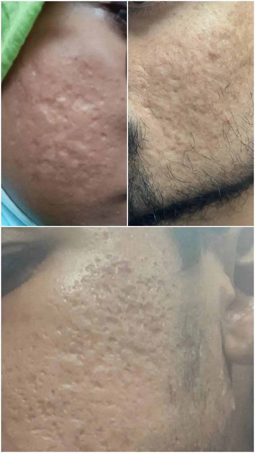 Before and after boxcar acne scars treatment by Dr. Amrika Seshadri